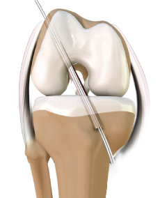 ACL Reconstruction