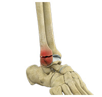 Ankle Fractures