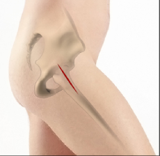 Anterior Hip Replacement

