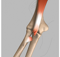 Biceps Tendon Tear at the Elbow