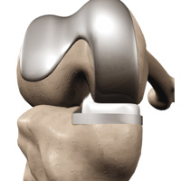 ConforMIS<sup>®</sup> Knee Replacement