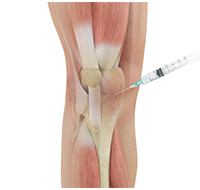 Cortisone Injection
