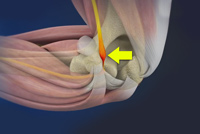 Ulnar Nerve Entrapment (Cubital Tunnel Syndrome)