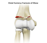 Distal Humerus Fractures of the Elbow