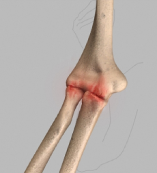 Elbow Arthritis