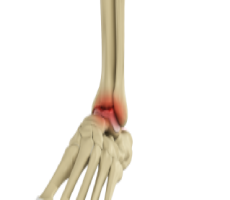 Foot & Ankle Arthritis