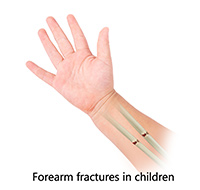 Forearm Fractures in Children