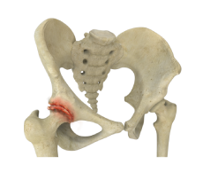 Hip Arthritis