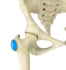 Hip Bursitis