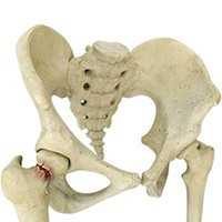 Hip Fracture