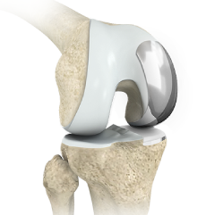 Partial Knee Replacement