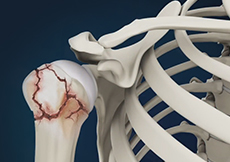 Proximal Humerus Fractures