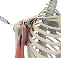 Ultrasound Guided Shoulder Injections