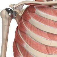 Shoulder Joint Replacement