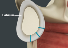 Shoulder Labrum Tear