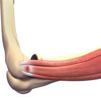 Tennis Elbow Surgery