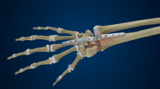 Total Wrist Arthrodesis